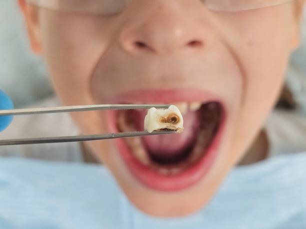 Best Emergency Treatment for Dental Infections or Abscesses in Cumberland, KY