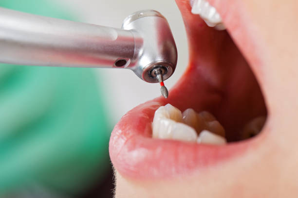 Best Emergency Tooth Extraction in Cumberland, KY
